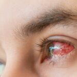 Corneal Abrasion